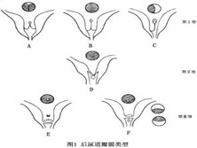 小儿后尿道瓣膜