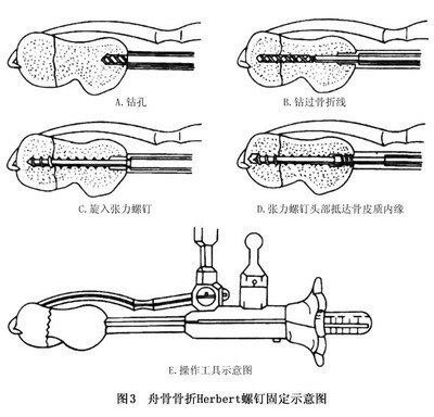 足舟骨骨折