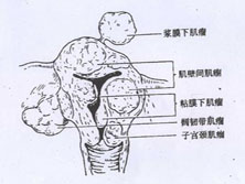 妊娠合并子宫肌瘤