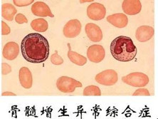 小儿骨髓增生异常综合征