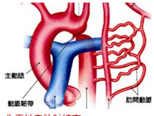 先天性主动脉缩窄