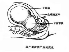 软产道异常性难产