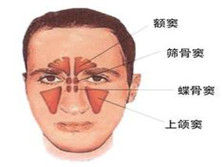 化脓性鼻窦炎