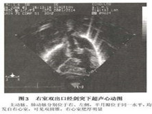 小儿右室双出口