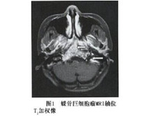 颅骨巨细胞瘤