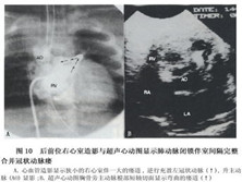 小儿室间隔完整型肺动脉闭锁