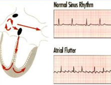 小儿心房扑动