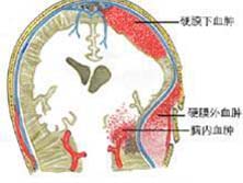 硬脑膜下血肿