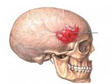 硬脑膜外血肿