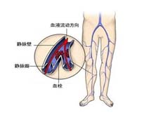 原发性下肢深静脉瓣膜关闭不全