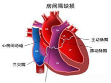 小儿致心律失常性右室心肌病