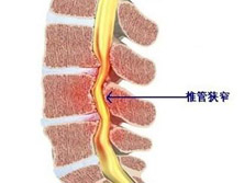 腰椎管狭窄