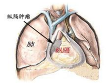 心包胸腺瘤