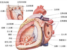 心肌梗塞并发左心室室壁瘤