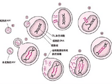 新生儿获得性免疫缺陷综合征