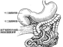 先天性肠旋转异常