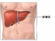 营养不良性肝硬化